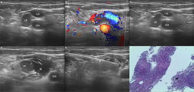 Comparison of Ultrasound-Guided Core Needle Biopsy Under the Assistance of Hydrodissection With Fine Needle Aspiration in the Diagnosis of High-Risk Cervical Lymph Nodes: A Randomized Controlled Trial